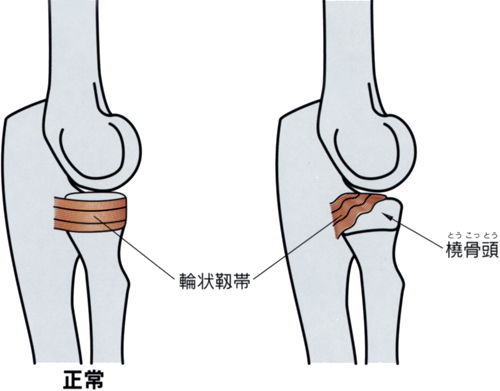 肘内障_03