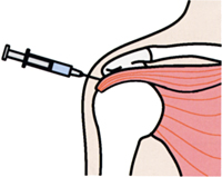 五十肩_関節注射