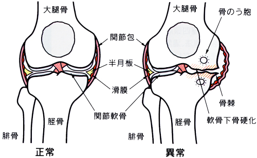 変形性膝関節症 真田整形外科