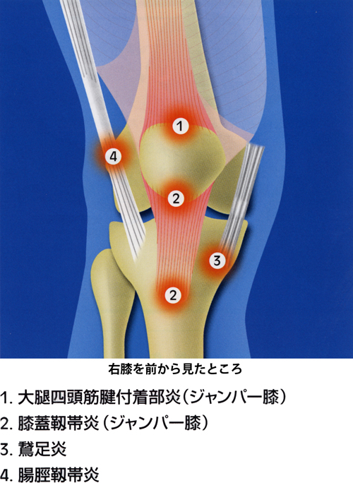 膝の慢性疼痛_04