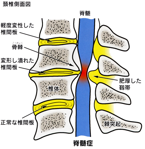 頚椎症_01_1