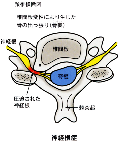 頚椎症_01_2