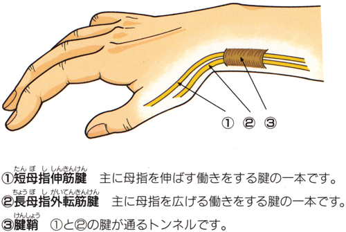 ケルバン腱鞘炎_02