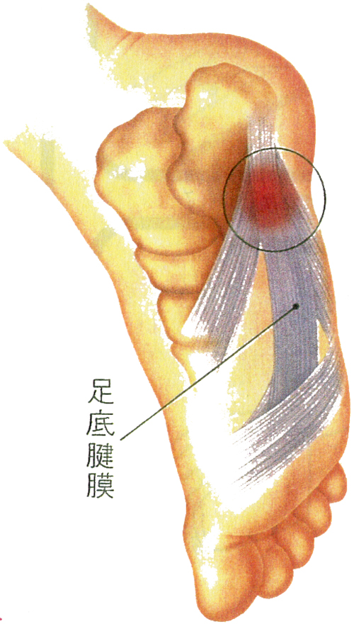 足底腱膜炎