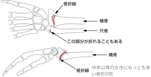 撓骨遠位端骨折_03