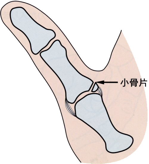 つき指 真田整形外科