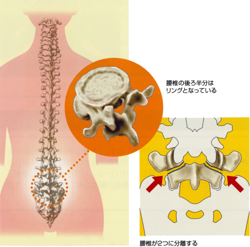 腰椎分離症_01