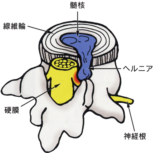 腰椎椎間板_01